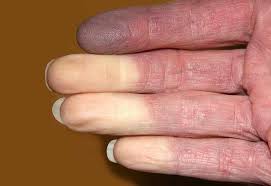 Raynaud fenomeni.