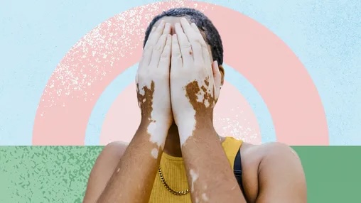 vitiligo ile yaşayan nilay'ın hikayesi - yazan: nur sümer - fonksiyonelyasamc.om